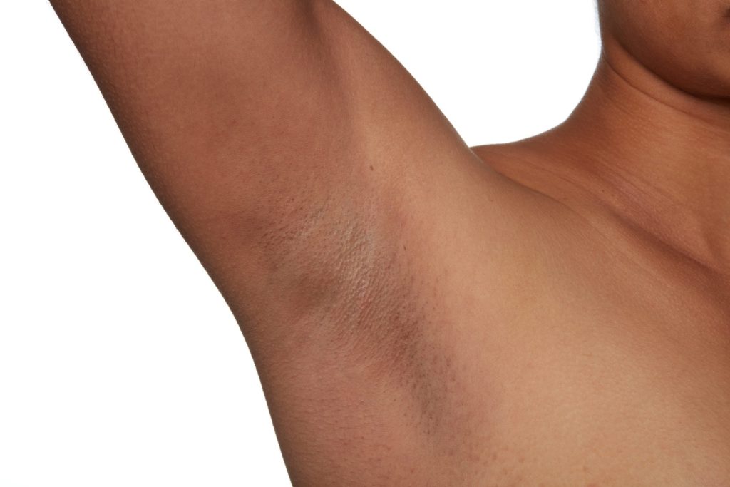 Before treatment image of right Armpit