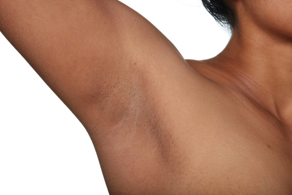 After treatment image of right Armpit