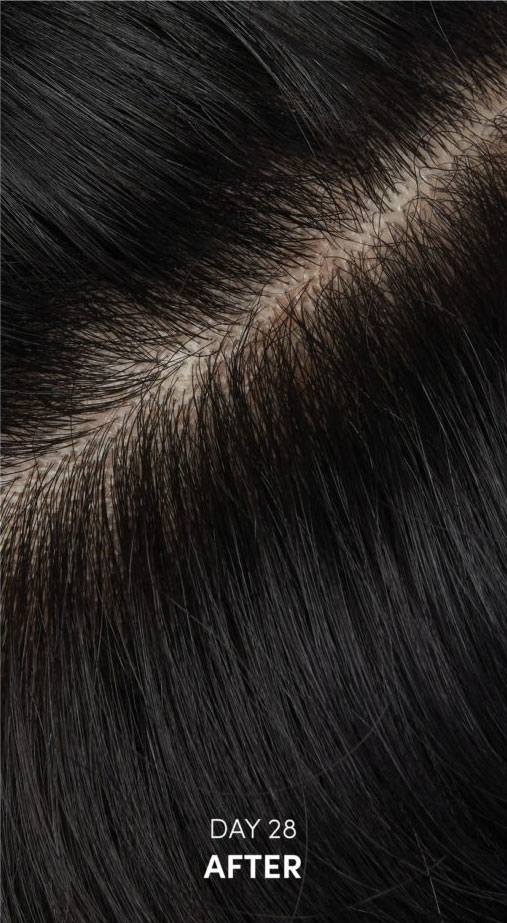 Dandruff related picture of hair after treatment