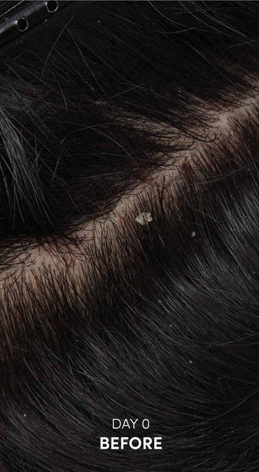Dandruff related picture of hair before treatment